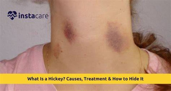 Are hickeys inappropriate?