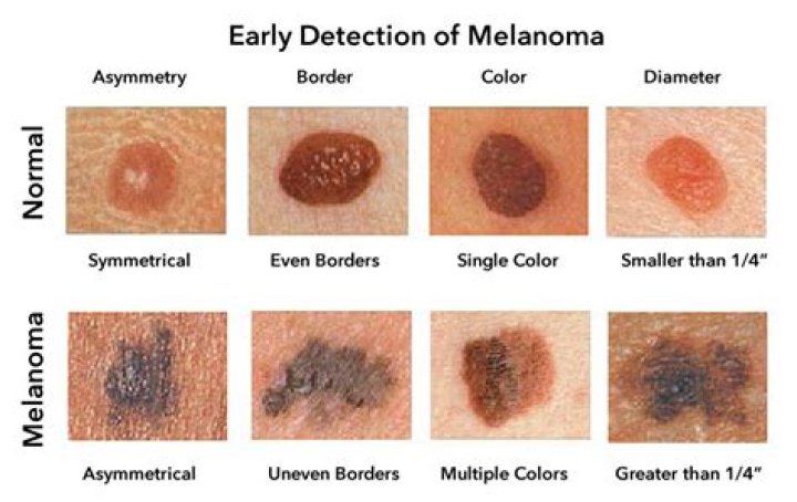 Can a melanoma appear overnight?