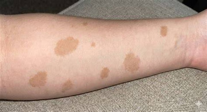 Can you have multiple café-au-lait spots without neurofibromatosis?