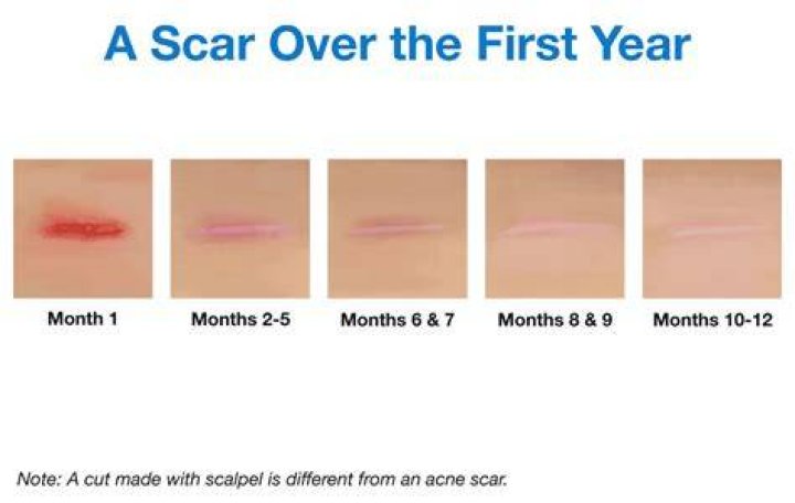 How long do small scars take to fade?