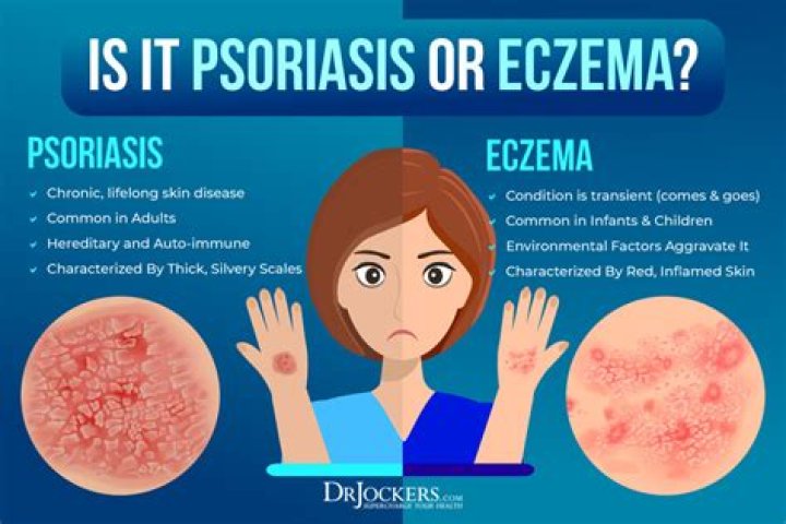 Is eczema autoimmune Related?