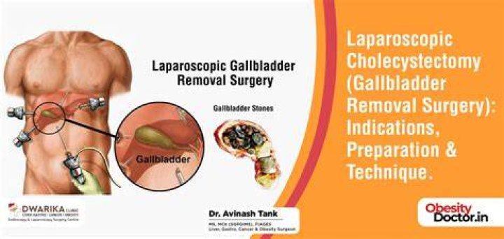 Is gallbladder removal a good idea?