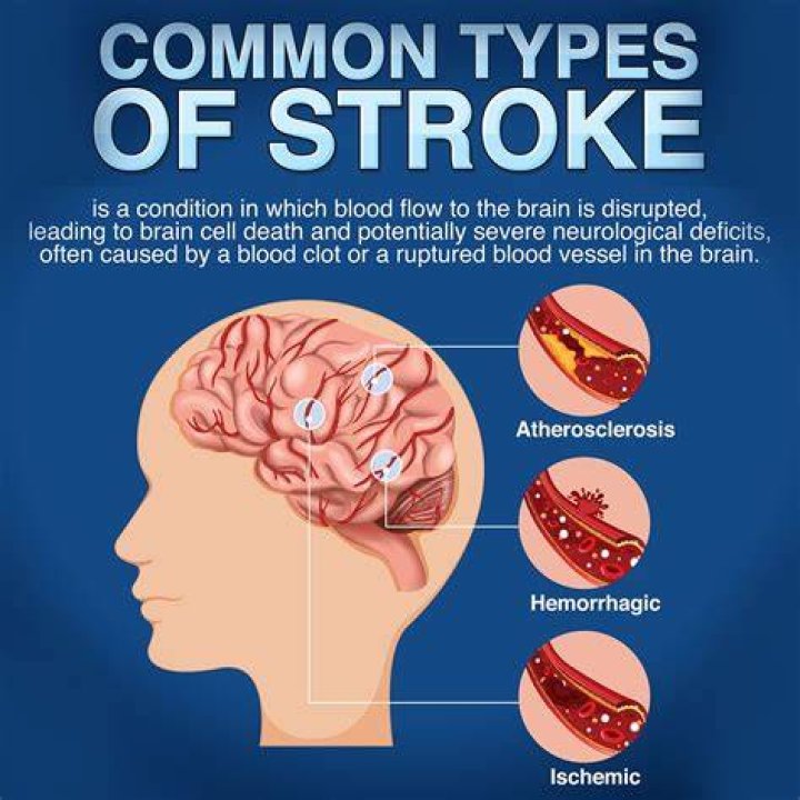 What BP can cause a stroke?