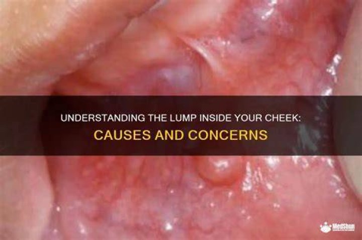 What causes lump inside cheek?