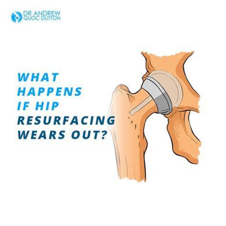 What happens when hip replacement wears out?