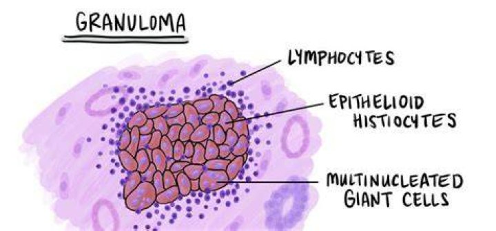 What is a granuloma?
