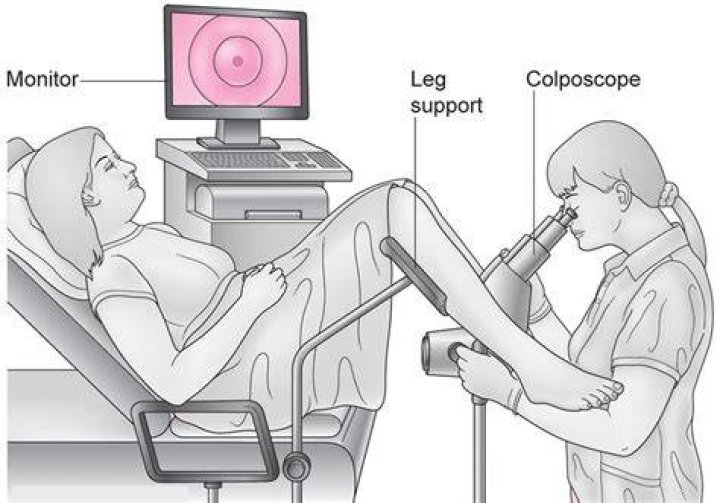 What patient position is used to perform a colposcopy?