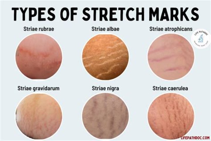 Why would a skinny person have stretch marks?